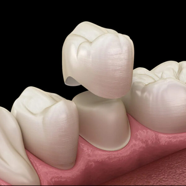 PORCELAIN crown (PFM)