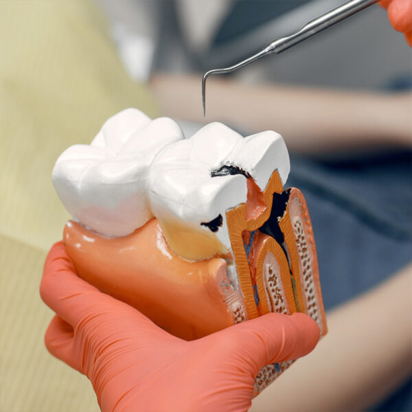 Dental Filling